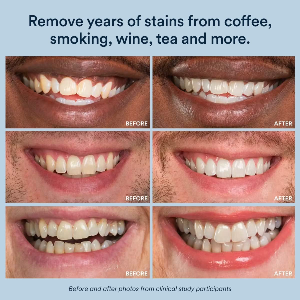 Auraglow Teeth Whitening Kit with LED Light Auraglow Teeth Whitening Kit with LED Light - Image 6