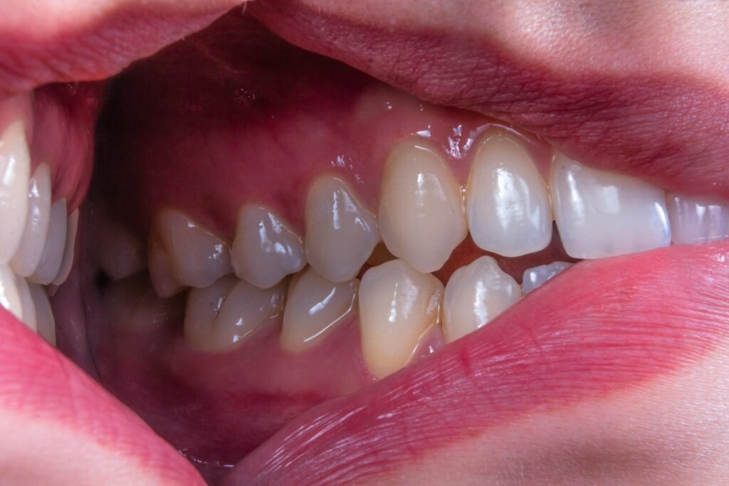AI Oral Precancer Detection: Smarter Than a Specialist? a person's mouth with teeth showing