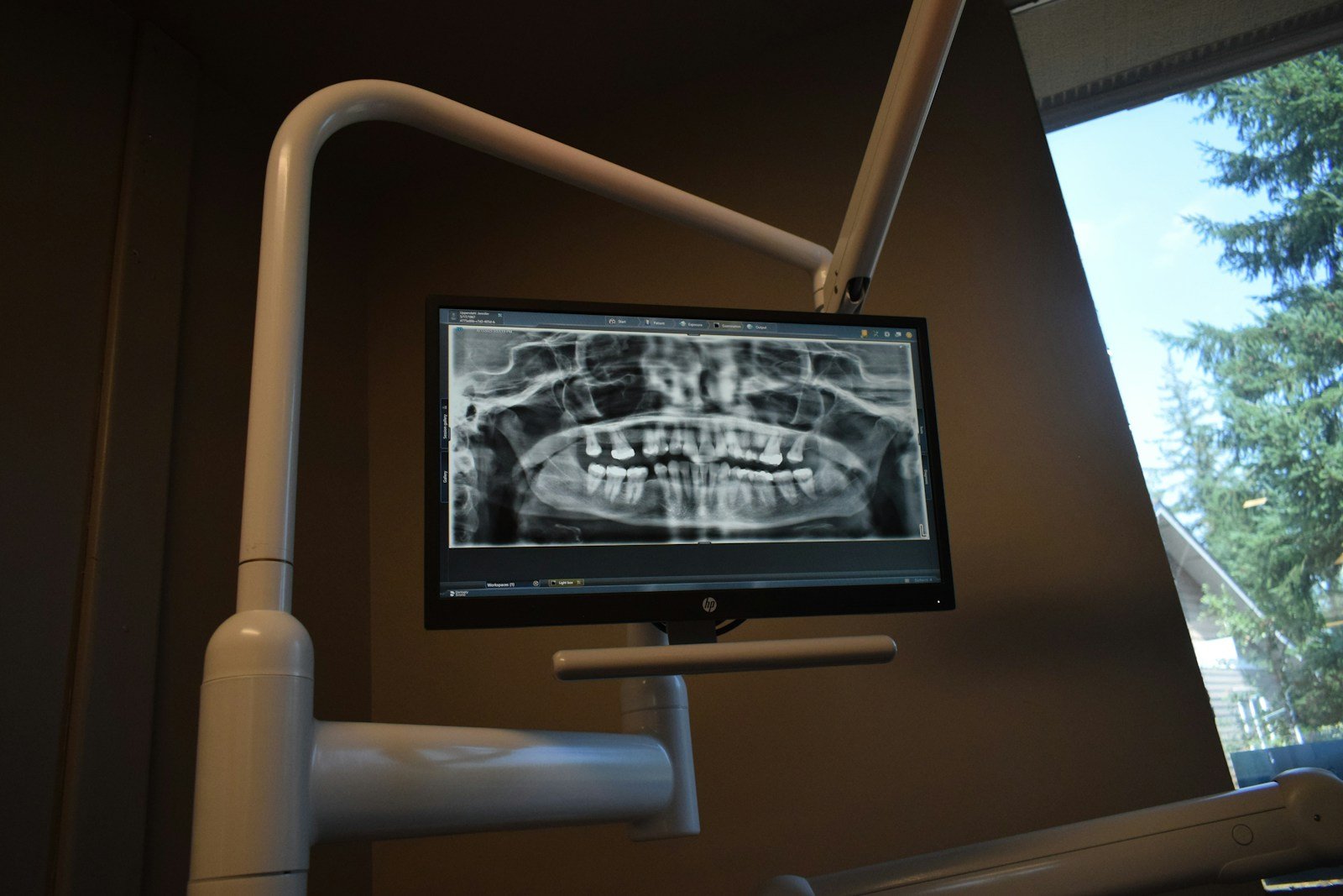 ChatGPT vs. Radiologist: Can AI Read a Dental Radiograph? Dental x-ray displayed on a monitor in a clinic.