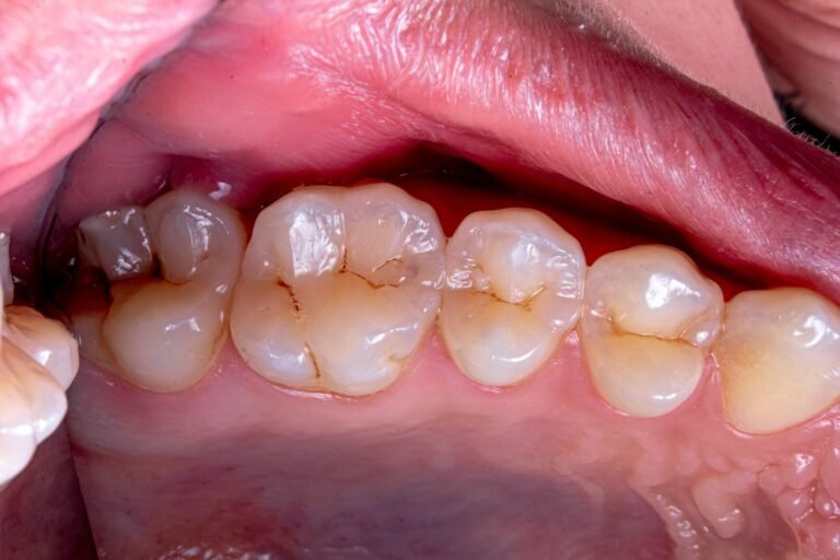 AI Teeth Crowding Check: Can a Photo Replace the Mold?
