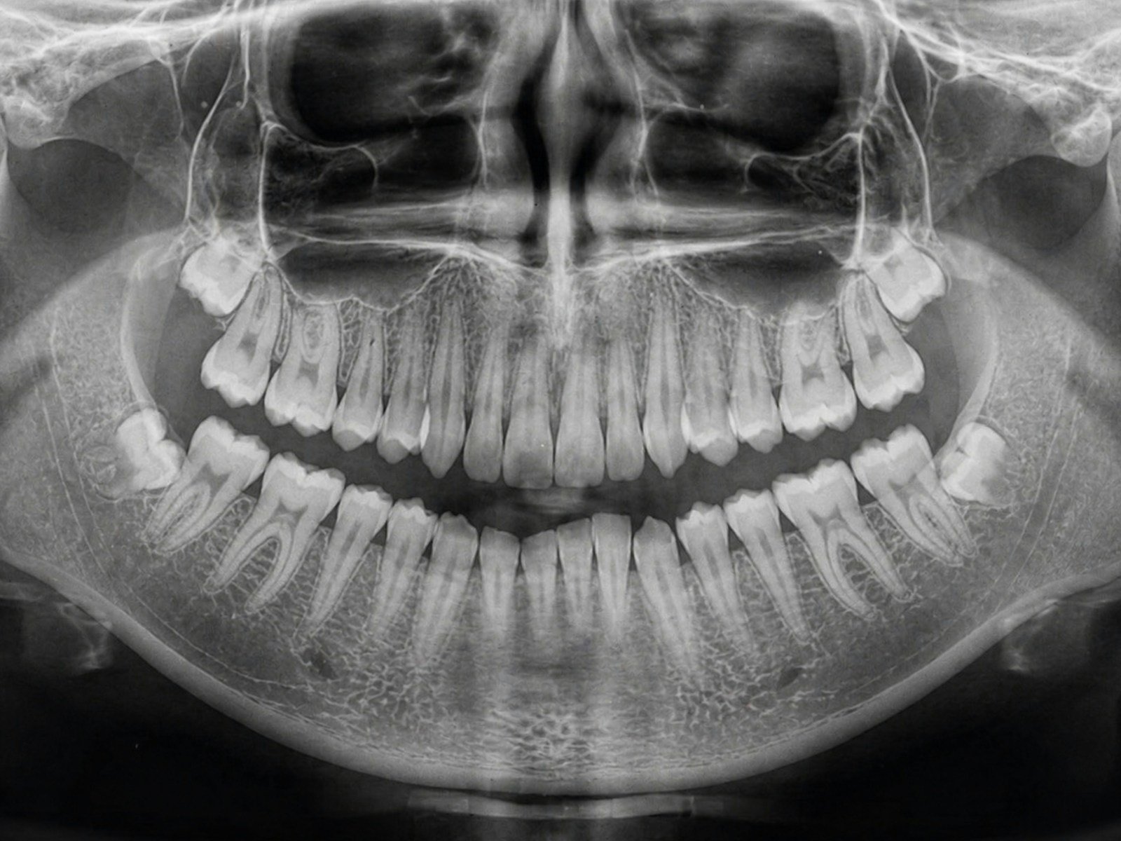 AI Periodontitis Staging: Real Diagnosis or Guesswork? Panoramic dental x-ray showing teeth and jawbone